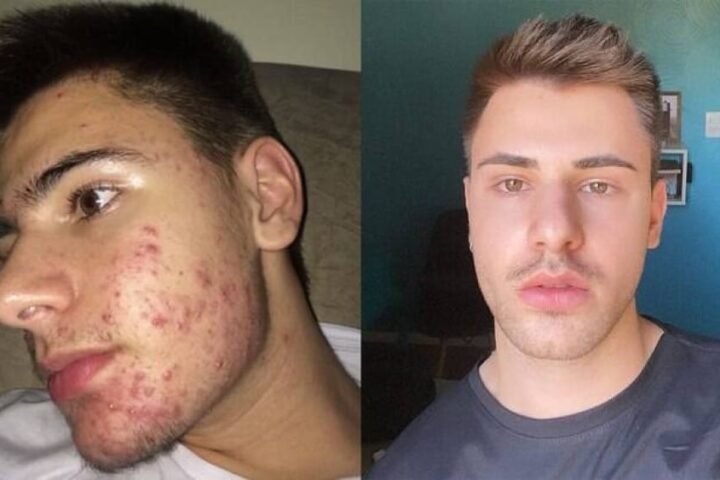 Dra. Alessandra Moschen explica como o Roacutan atua no tratamento da Acne