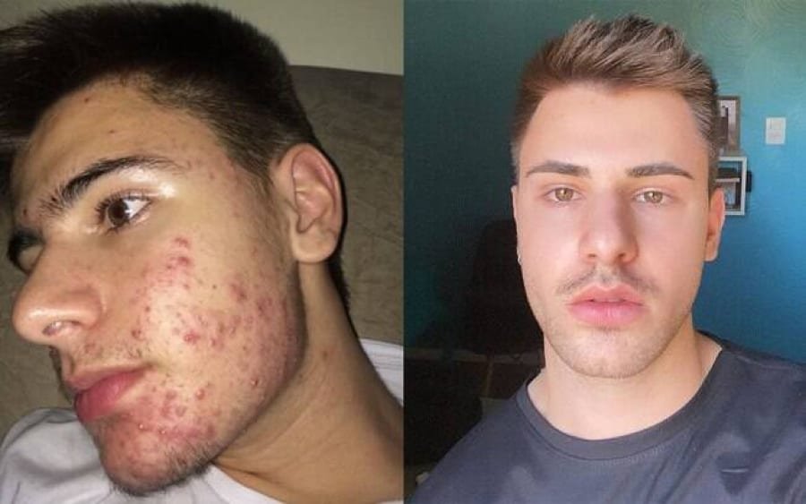 Dra. Alessandra Moschen explica como o Roacutan atua no tratamento da Acne